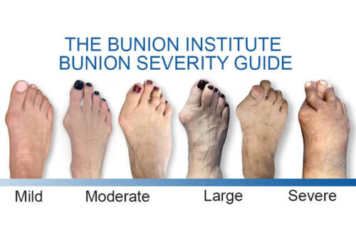 Travelling with a Bunion